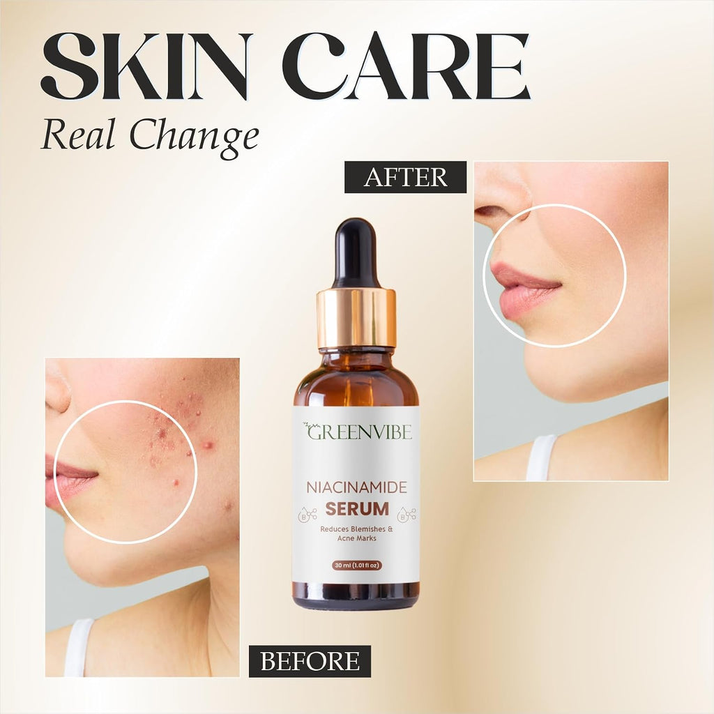 Niacinamide Face Serum 30ml | 10% Niacinamide + Zinc PCA + Hyaluronic Acid | Minimizes Pores | Controls Oil | Brightens Skin | For Oily, Combination & Blemish-Prone Skin | All Skin Types