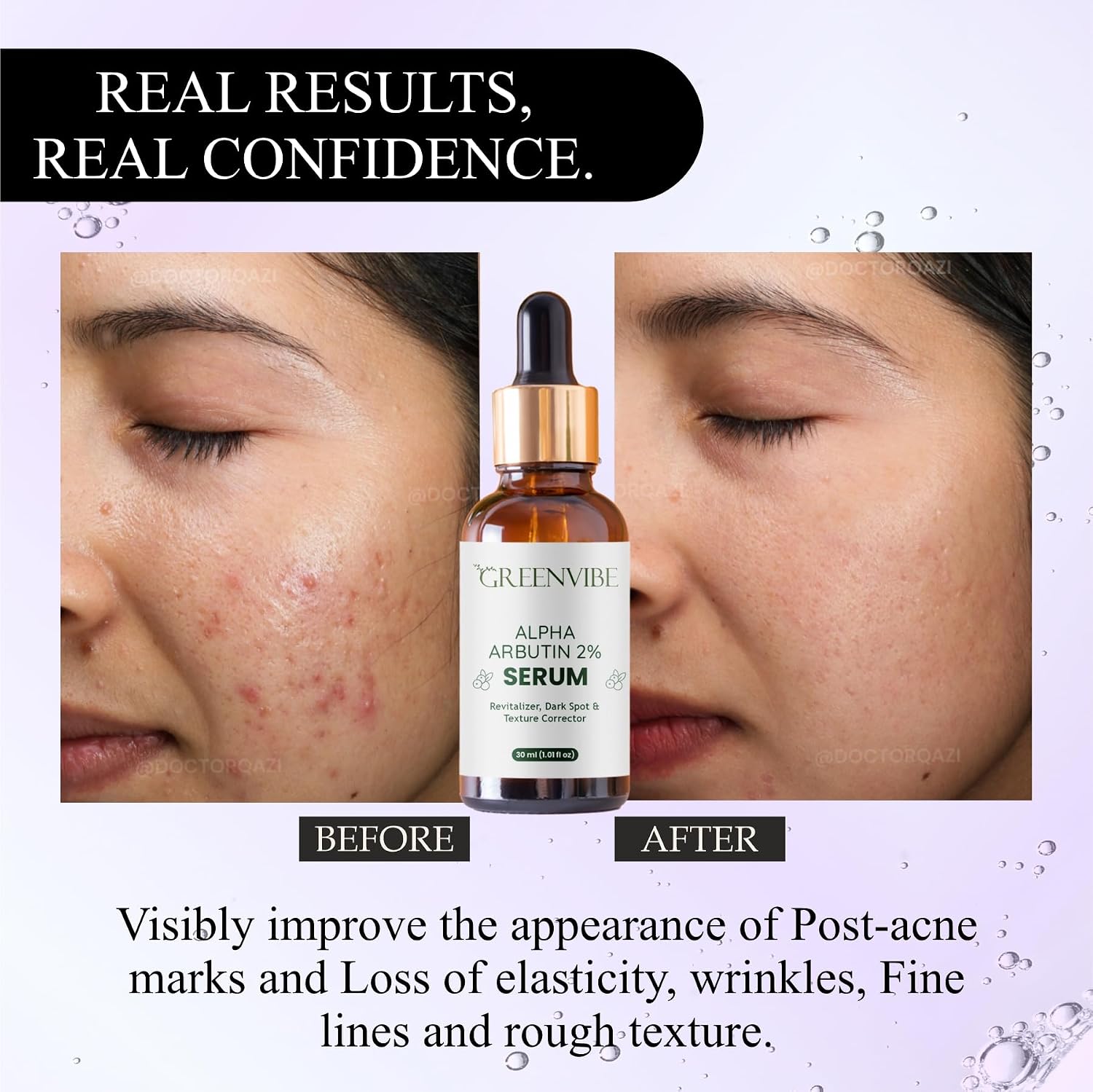 Greenvibe Alpha Arbutin 2% Face Serum for Dark Spots, Hyperpigmentation & Uneven Texture – Made in India, 30ml Brightening & Skin Revitalizer
